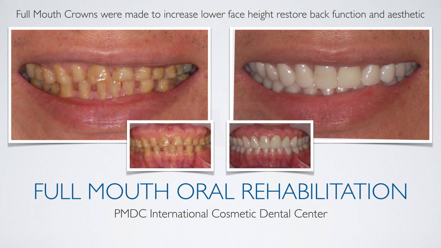 FULL MOUTH ORAL REHABILITATION PMDC Dental